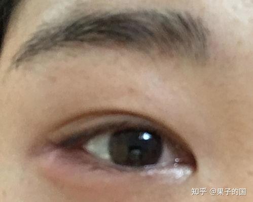 长针眼图片,长针眼症状与诊断解析